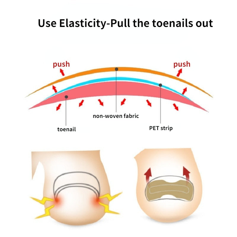 EasyPatches™ Cure Ingrown Toenails & Nail Fungus! Fast, Effective & Painless